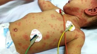 Bệnh nhân mắc bệnh viêm màng não mô cầu.