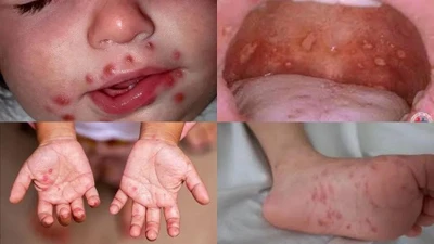 Trẻ mắc bệnh tay chân miệng