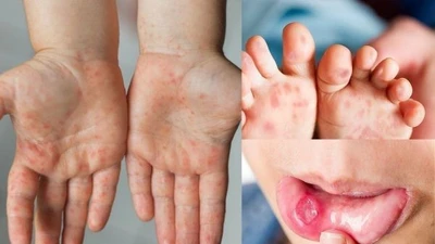 Dịch sốt xuất huyết, tay chân miệng tại TP Hồ Chí Minh vẫn phức tạp.