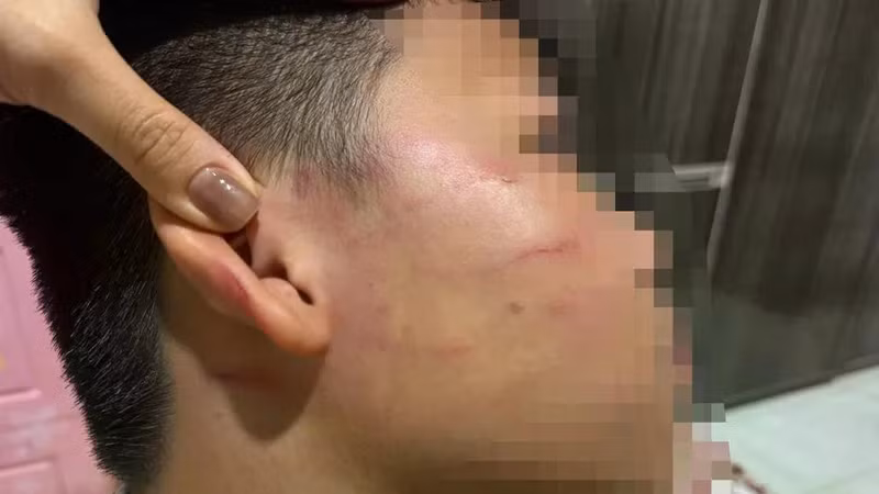 Gia Lai: Học sinh lớp 4 bị thầy giáo tát gây thương tích nặng