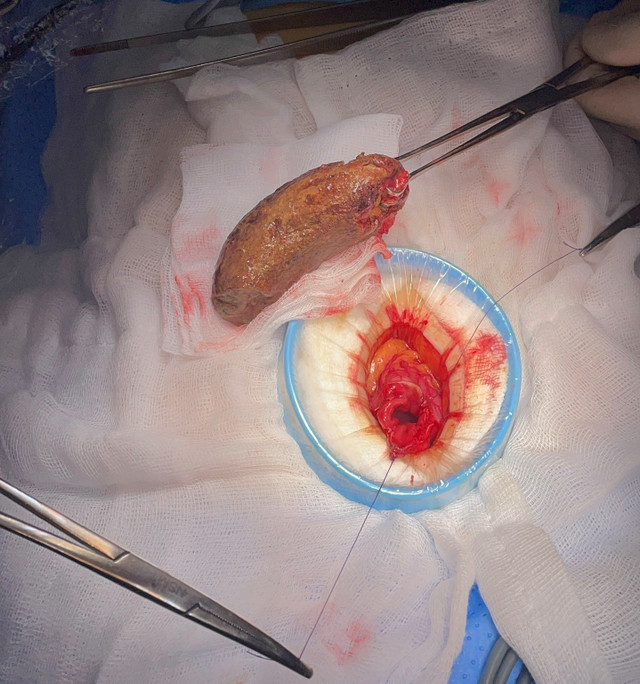 Bệnh nhân bị u bã thức ăn, thủng dạ dày vì sử dụng tinh bột nghệ - Ảnh BVCC tinh-bot-nghe-2.jpg