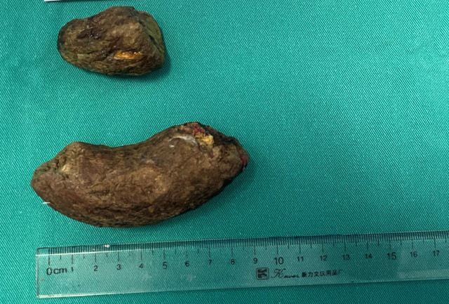 U bã thức ăn vì lạm dụng tinh bột nghệ - Ảnh BSCC tinh-bot-nghe-3-3042.jpg