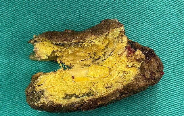 Khối u bã thức ăn được bổ ra chứa các tinh bột nghệ chưa được phân hủy - Ảnh BVCC tinh-bot-nghe-4-1209.jpg