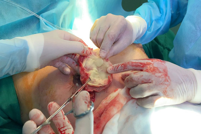 Benh vien tham my JW mo cap cuu cho benh nhan bi spa bo quen gac y te trong nguc nhu the nao?