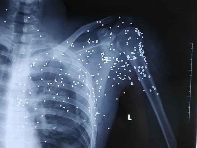 Thanh niên trong vụ nổ súng ở trạm BOT vẫn chưa qua cơn nguy kịch - Hình 3 Thanh nien trong vu no sung o tram BOT van chua qua con nguy kich-Hinh-3