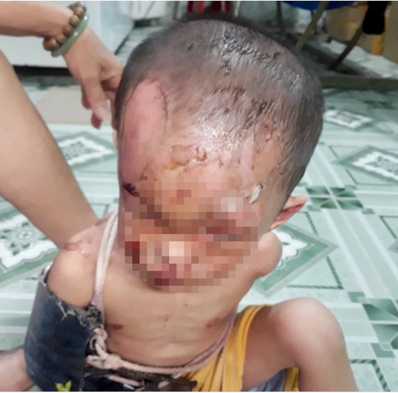 Nhìn thấy thương hình ảnh bé trai hơn 1 tuổi bị bạo hành dã man - Hình 2 Nhin thay thuong hinh anh be trai hon 1 tuoi bi bao hanh da man-Hinh-2
