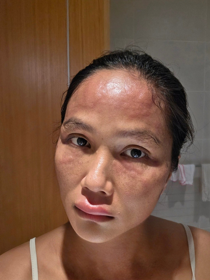 H'hen Niê cho biết, cứ mỗi buổi chiều, cô lại bị nổi mề đay. Sau 4 ngày, tình trạng ngứa, sưng của cô đã giảm dần. Ảnh: FB H'hen Niê.