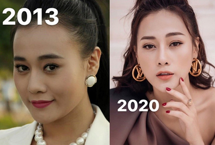 "Thông thường, một gương mặt sau khi phẫu thuật sẽ phải mất 2 - 3 tháng mới có thể hoàn thiện và 6 tháng mới trông thật hoàn hảo. Tôi tin rằng sau khoảng thời gian này, khi các nét trở nên hài hòa, mình sẽ không khiến mọi người thấy thất vọng hay xa lạ vì diện mạo mới", Hoa Học Trò dẫn lời Phương Oanh. Ảnh: Vietnamnet.