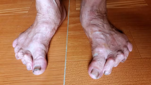 Biết gì về “bàn chân Giao Chỉ” của người Việt cổ? - Hình 6 Biet gi ve “ban chan Giao Chi” cua nguoi Viet co?-Hinh-6