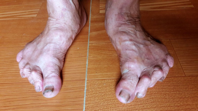 Biết gì về “bàn chân Giao Chỉ” của người Việt cổ? - Hình 6 Biet gi ve “ban chan Giao Chi” cua nguoi Viet co?-Hinh-6