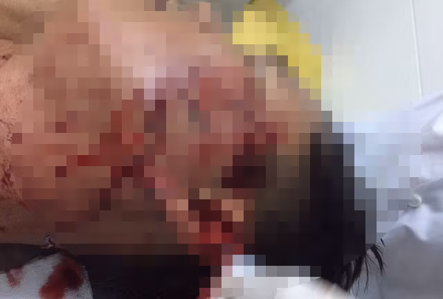 8X dap coc bia vao mat dai uy cong an gay thuong tich 15%