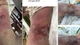 Người đàn ông 59 tuổi nhiễm vi khuẩn Vibrio vulnificus gây hoại tử da nhanh
