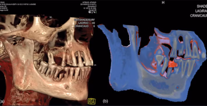 Các nhà nghiên cứu đã tìm thấy một khoang xốp trong răng của xác ướp này chứa đầy vật liệu trám bảo vệ. Ảnh: @Bảo tàng Khảo cổ học Quốc gia Athens.