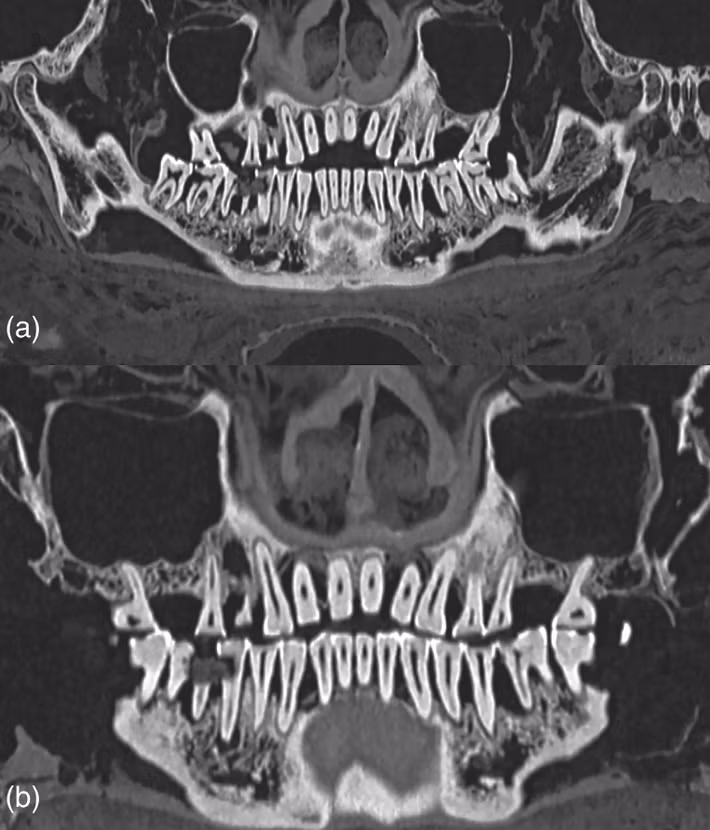 Để có được kết luận này, các chuyên gia đã sử dụng kỹ thuật chụp cắt lớp vi tính (CT) để mô tả đầy đủ về răng xác ướp Ai Cập. Ảnh: @Bảo tàng Khảo cổ học Quốc gia Athens.