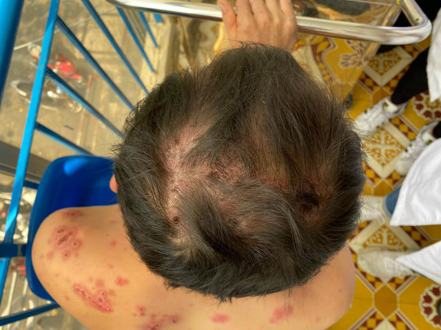 Biết gì về bệnh Rowell hiếm gặp khiến bệnh nhân lở loét toàn thân? - Hình 4 Biet gi ve benh Rowell hiem gap khien benh nhan lo loet toan than?-Hinh-4