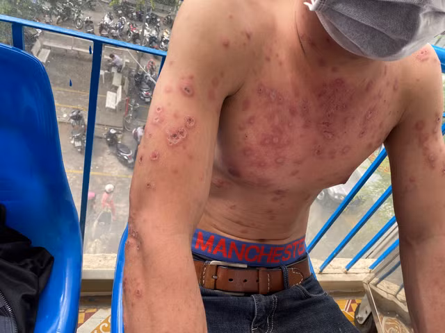 Biet gi ve benh Rowell hiem gap khien benh nhan lo loet toan than?-Hinh-2