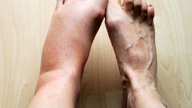 Dấu hiệu cảnh báo sớm tiểu đường tuýp 2 nguy hiểm Dau hieu canh bao som tieu duong tuyp 2 nguy hiem