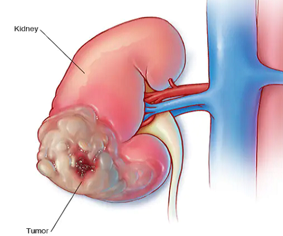 Lưu ý loạt triệu chứng ung thư thận nhiều người bỏ qua Luu y loat trieu chung ung thu than nhieu nguoi bo qua