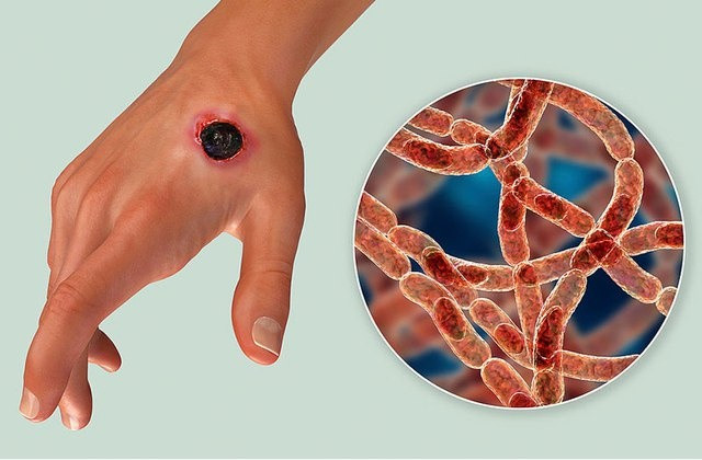 Các cách phòng tránh bệnh than gây loạt biến chứng nguy hiểm Cac cach phong tranh benh than gay loat bien chung nguy hiem