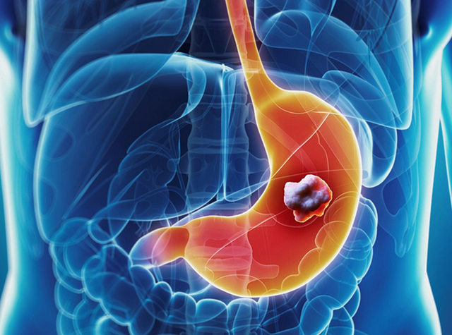 8 trieu chung hiem gap canh bao ung thu da day