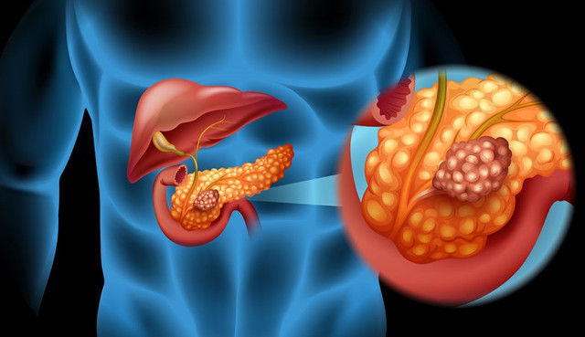 Lưu ý những triệu chứng cảnh báo sớm ung thư tuyến tụy Luu y nhung trieu chung canh bao som ung thu tuyen tuy