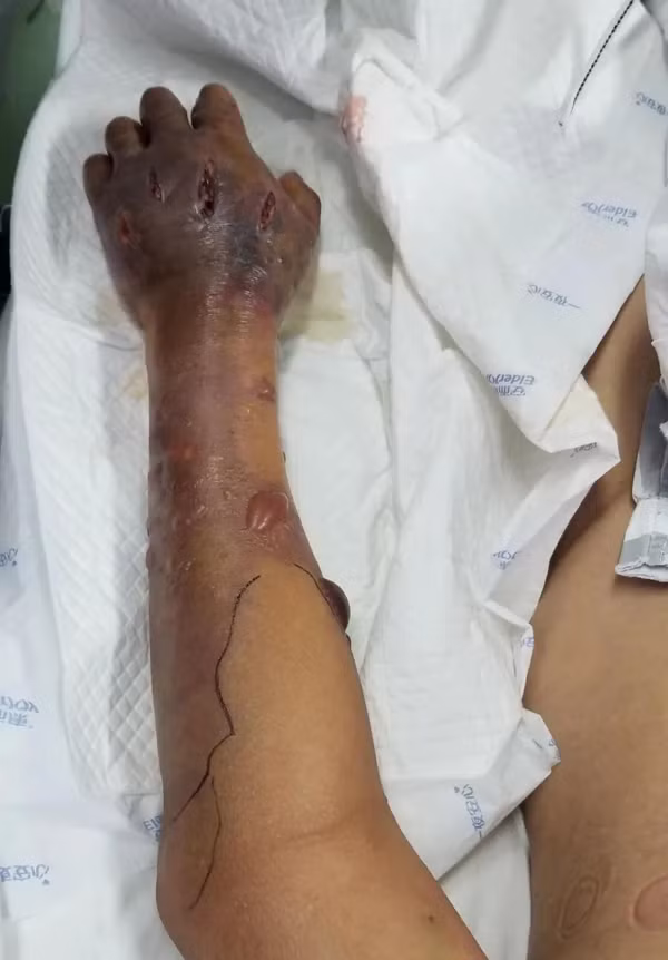 Dung tay rua ca, lao ngu nhiem vi khuan 'an thit nguoi'