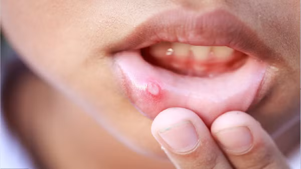 Những tổn thương “tiền ung thư” không được bỏ qua - Hình 9 Nhung ton thuong “tien ung thu” khong duoc bo qua-Hinh-9