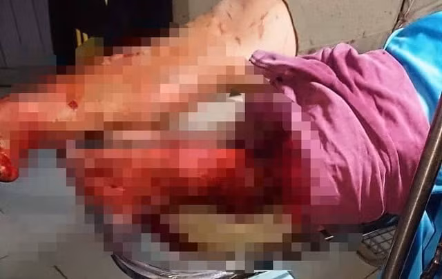 Thanh niên 17 tuổi chém đứt lìa chân người khác vì lý do không tưởng Thanh nien 17 tuoi chem dut lia chan nguoi khac vi ly do khong tuong