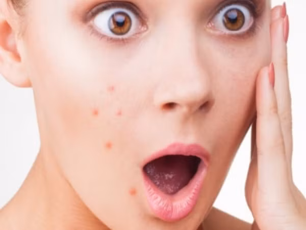 Đây là giải pháp toàn diện đối phó với mụn trứng cá trong chu kỳ kinh nguyệt - Hình 2 Day la giai phap toan dien doi pho voi mun trung ca trong chu ky kinh nguyet-Hinh-2