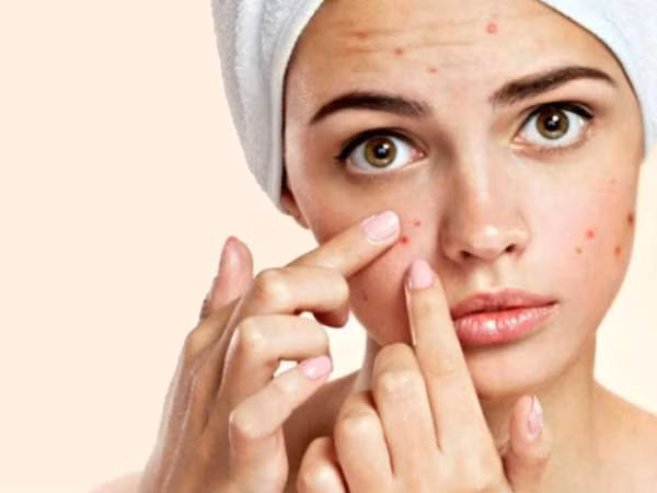Đây là giải pháp toàn diện đối phó với mụn trứng cá trong chu kỳ kinh nguyệt - Hình 4 Day la giai phap toan dien doi pho voi mun trung ca trong chu ky kinh nguyet-Hinh-4