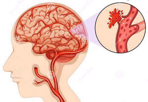 Dấu hiệu cảnh báo xuất huyết não cần hết sức cảnh giác - Hình 2 Dau hieu canh bao xuat huyet nao can het suc canh giac-Hinh-2