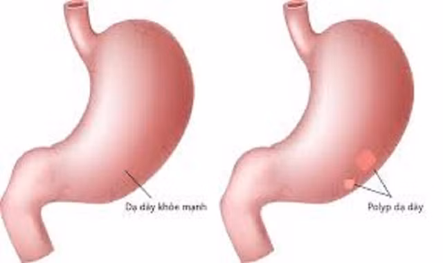 Lưu ý 4 bệnh vặt không chữa sớm dễ chuyển thành ung thư - Hình 9 Luu y 4 benh vat khong chua som de chuyen thanh ung thu-Hinh-9