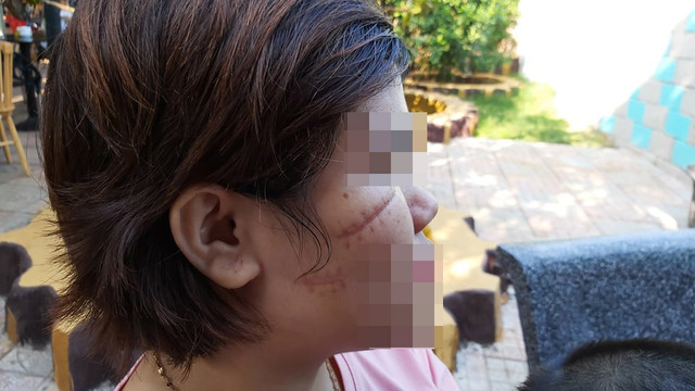 Nhóm côn đồ rạch mặt dã man nữ công nhân ở Bà Rịa - Vũng Tàu Nhom con do rach mat da man nu cong nhan o Ba Ria - Vung Tau
