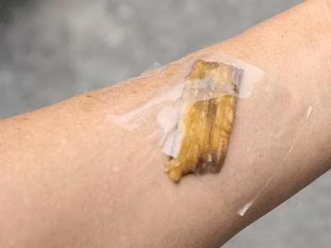  Bạn có thể dùng phần bên trong của vỏ chuối đắp lên phần da bị mụn cóc, sau đó cố định chặt bằng vải. Thực hiện việc này 3-4 lần, mụn cóc trên da sẽ được loại bỏ. Ảnh: ytimg. 