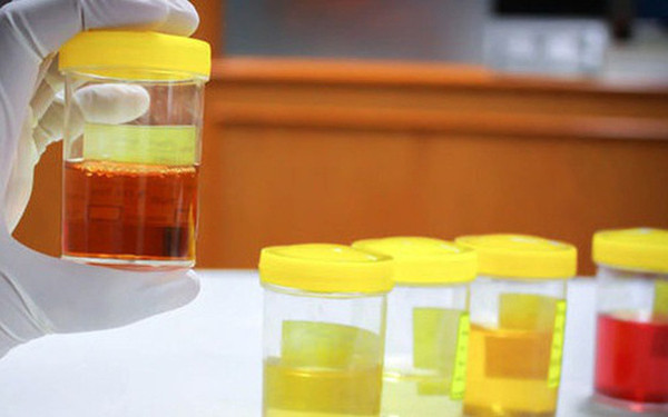 Lúc này, nước tiểu thải ra sẽ có màu đục, vàng như nước chè đặc để lâu. Tình trạng sẽ không thay đổi nhiều dù bạn bổ sung nước trong ngày.