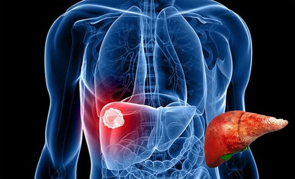 Giống như các bộ phận khác trên cơ thể, gan có khả năng tự sửa chữa. Vậy nhưng, duy trì thói quen không tốt như uống rượu bia, thức khuya, ăn uống không khoa học...thời gian dài sẽ khiến gan bị tổn thương nghiêm trọng như gan nhiễm mỡ, xơ gan, ung thư gan.
