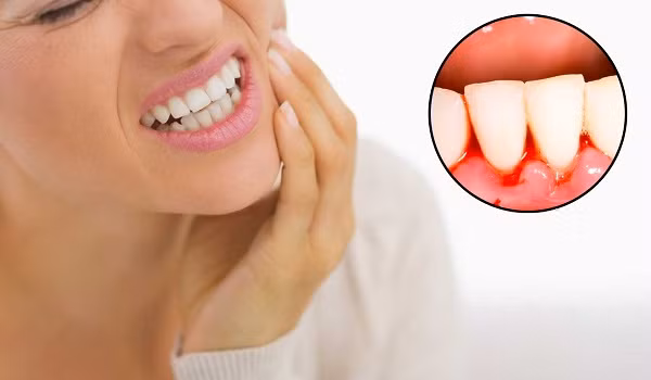 Chảy máu nướu không rõ nguyên nhân: Chảy máu nướu có thể bắt nguồn do nóng trong hoặc nướu nhạy cảm. Tình trạng này sẽ sớm hết nếu bạn áp dụng chế độ ăn uống phù hợp.