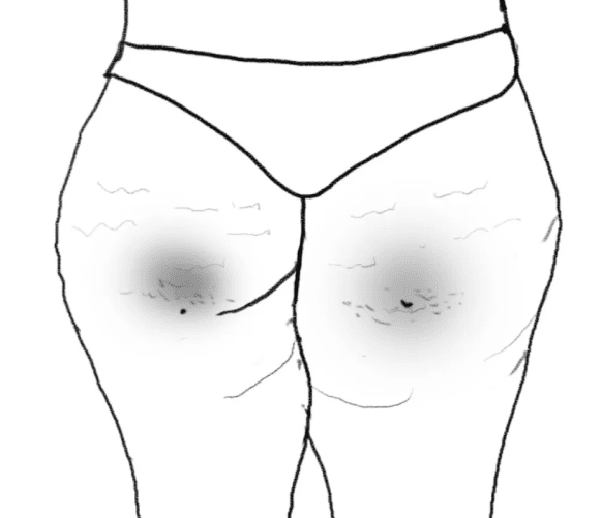 Ổn định sắc tố melanin. Màu da cơ thể chủ yếu do hàm lượng sắc tố melanin quyết định. Những bộ phận tập trung càng nhiều hắc tố thì làn da càng sẫm màu. So với các khu vực khác, vùng sinh dục có mật độ melanin cao nhất. Lượng hắc tố ở mông thấp hơn so với vùng sinh dục song có hiện tượng tăng sản tế bào hắc tố trên một số vùng da, làm tăng mật độ hắc tố tại chỗ gây đen da, biểu hiện ra bên ngoài là 2 vết sạm đen trên mông rõ rệt.