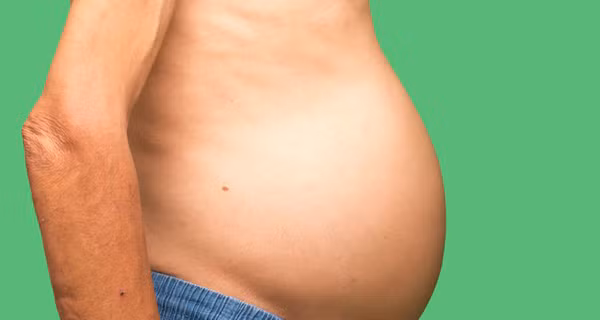 Cổ trướng. Cổ trướng” hay còn gọi là “báng bụng”, Cổ trướng là tình trạng tích tụ dịch bệnh lý hay nước trong khoang phúc mạc. Dịch cổ trướng thường là huyết thanh - dạng chất lỏng màu vàng và trong suốt tích tụ trong khoang bụng.