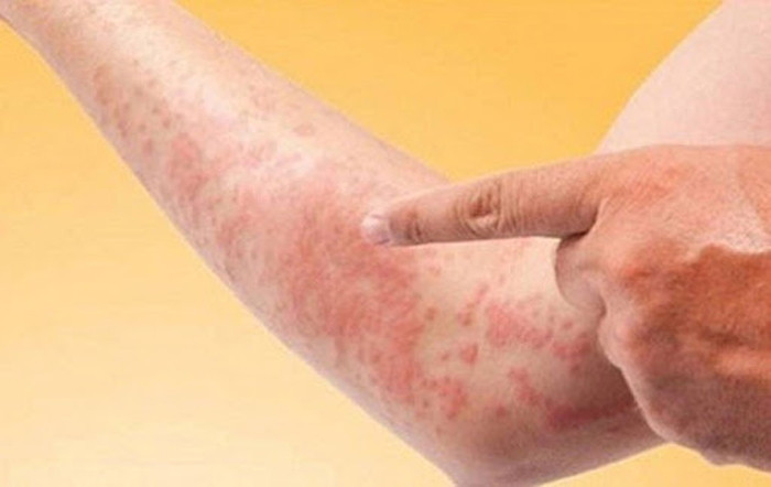 Hàu tốt song không phải tốt với tất cả trường hợp, đặc biệt người có tiền sử dị ứng hải sản. Với thành phần chính từ hàu sống hoặc sò sống, bất chấp sử dụng dầu hào có thể khiến người dị ứng hải sản đối diện với tình trạng nổi mề đay, ngứa ngáy, nôn nao khó chịu.