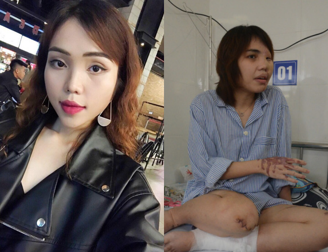 Chị Lê Thị Lan Vy (SN 1995, trú tại quận Thanh Khê, TP Đà Nẵng) bị chồng sắp cưới là Nguyễn Trương Nam Hải (SN 1995, thiếu úy thuộc lực lượng Cảnh sát PCCC, Công an Đà Nẵng đã bị tước quân tịch) tạt axit khi ngỏ lời chia tay do đối tượng này ghen tuông mù quáng