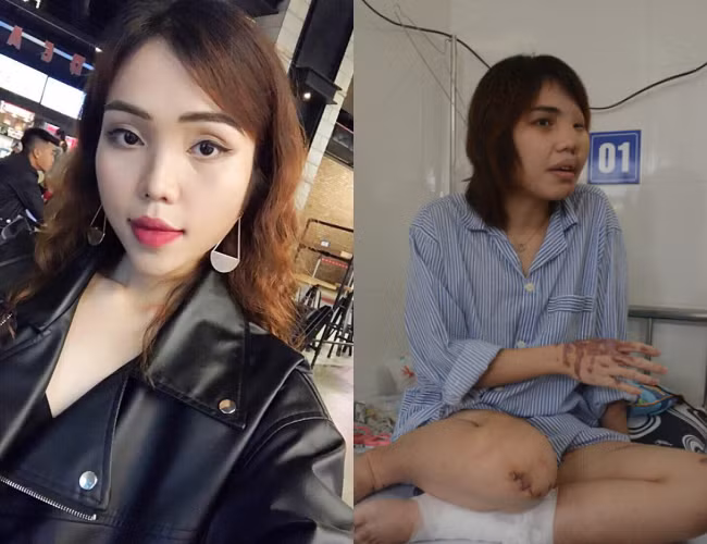 Chị Lê Thị Lan Vy (SN 1995, trú tại quận Thanh Khê, TP Đà Nẵng) bị chồng sắp cưới là Nguyễn Trương Nam Hải (SN 1995, thiếu úy thuộc lực lượng Cảnh sát PCCC, Công an Đà Nẵng đã bị tước quân tịch) tạt axit khi ngỏ lời chia tay do đối tượng này ghen tuông mù quáng