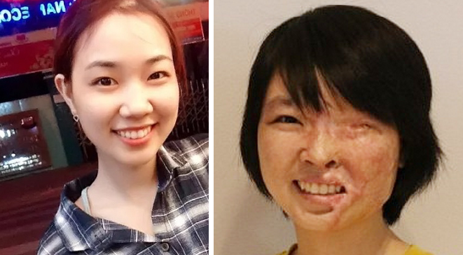 Hoàng Tăng Thị Thu Hương (20 tuổi, quê Đắk Lắk) bị tạt axit vào năm 2016 khi đang là sinh viên ở TP HCM. Cô bị bỏng 75% gương mặt, hỏng mắt trái, thị lực mắt phải còn 7.