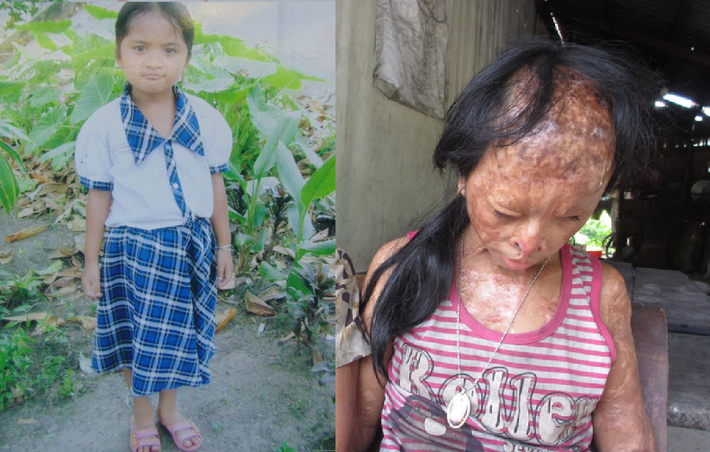 Nguyễn Thị Yến Nhi (SN 2005, tỉnh Vĩnh Long) đang sinh sống cùng bà nội của mình. Em là nạn nhân của vụ đánh ghen xảy ra vào 7 năm trước khi mẹ ruột của em giật chồng người khác, đẩy em vào cảnh tật nguyền khi hứng trọn ca axit vào người.