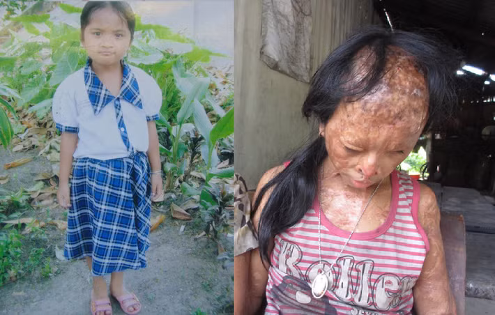 Nguyễn Thị Yến Nhi (SN 2005, tỉnh Vĩnh Long) đang sinh sống cùng bà nội của mình. Em là nạn nhân của vụ đánh ghen xảy ra vào 7 năm trước khi mẹ ruột của em giật chồng người khác, đẩy em vào cảnh tật nguyền khi hứng trọn ca axit vào người.