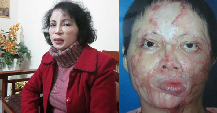 Chị Nguyễn Thị Kim Loan (SN 1965) được bổ nhiệm thành thẩm phán năm 1999. Năm 2005, một đối tượng đã tạt axit chị Loan do nữ thẩm phán không nhận tiền hối lộ trong một vụ án tranh chấp đất đai. Năm 2014, chị trở lại công tác tại TAND tối cao.