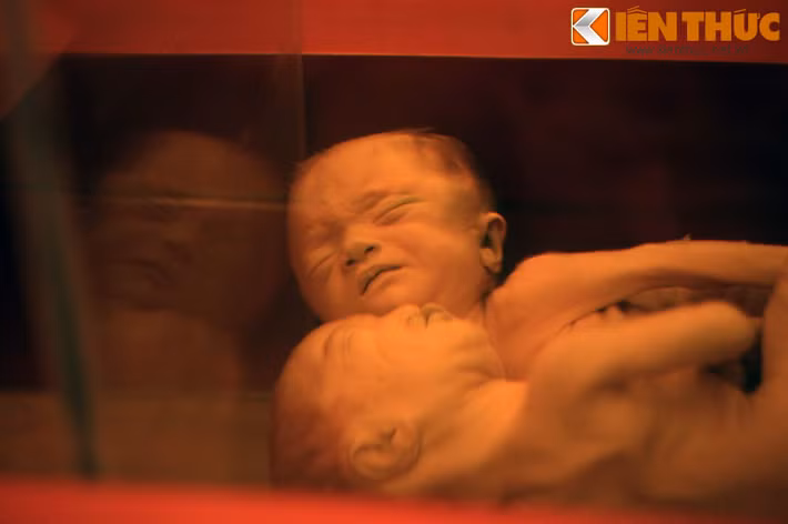 Thi hài hai em bé dính liền - nạn nhân chất độc da cam của Mỹ thời chiến tranh Việt Nam - là hiện vật đã khiến nhiều du khách rơi lệ khi chứng kiến.