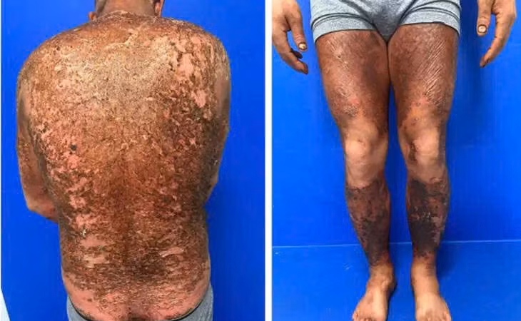 Đắp cao thảo dược tự chế, bệnh nhân vảy nến gặp biến chứng nặng