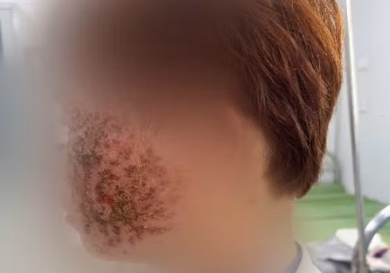 Phát hiện sớm eczema herpeticum giúp tránh biến chứng nguy hiểm
