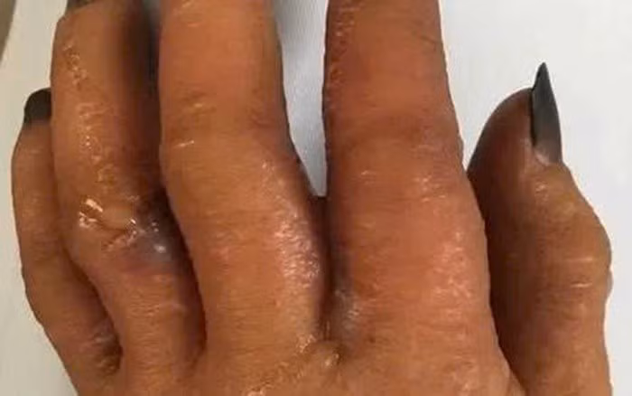 Nguy cơ dị ứng thuốc nhuộm tóc tăng cao, cần cẩn trọng khi dùng